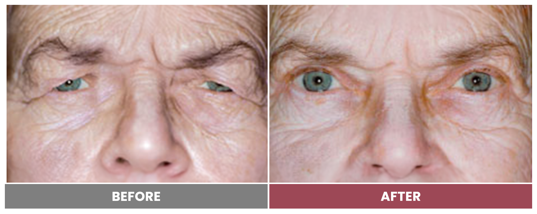 Upper Blepharoplasty - Case 67
